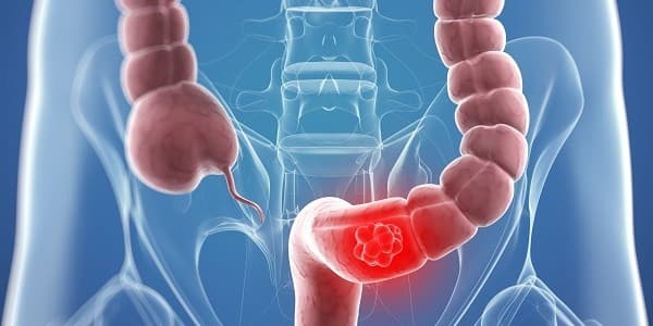 Ung thư đại tràng là gì?