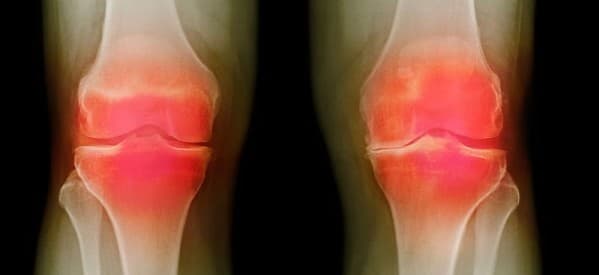 Dấu hiệu thoái hóa khớp2