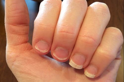 Nhận biết sớm các triệu chứng của bệnh nấm móng ta giúp chúng ta chủ động trong việc khám chữa và phòng bệnh.