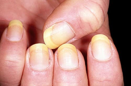 nam-mong-tay-co-lay-khong1