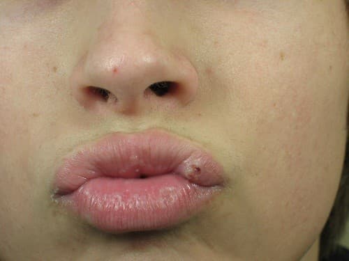 Sùi mào gà ở lưỡi là do vi rút HPV (human papiloma) gây nên, bệnh lây nhiễm từ người này sang người khác qua đường quan hệ tình dục không an toàn bằng đường miệng hoặc hôn người nhiễm bệnh sùi mào gà. 