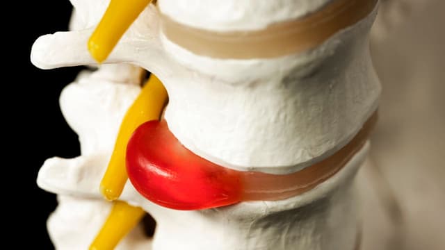 Bệnh thoát vị đĩa đệm có chữa khỏi được không?