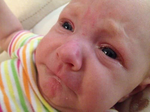 Các biến chứng bệnh đau mắt đỏ ở trẻ sơ sinh là rất hiếm gặp và trẻ có thể phục hồi hoàn toàn.