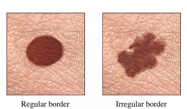 dau-hieu-ung-thu-da-hac-to