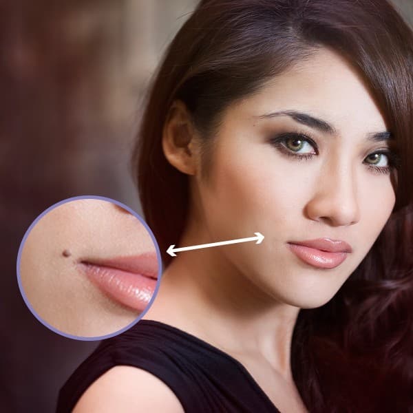 Dấu hiệu ung thư hắc tố