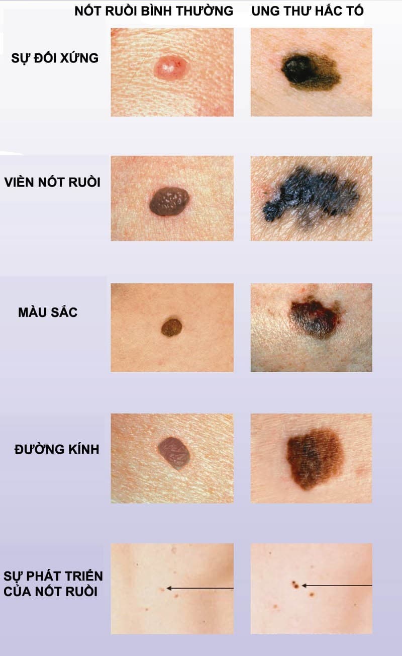 Các dấu hiệu ung thư hắc tố