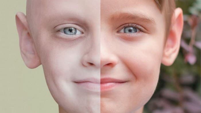 Dấu hiệu ung thư máu