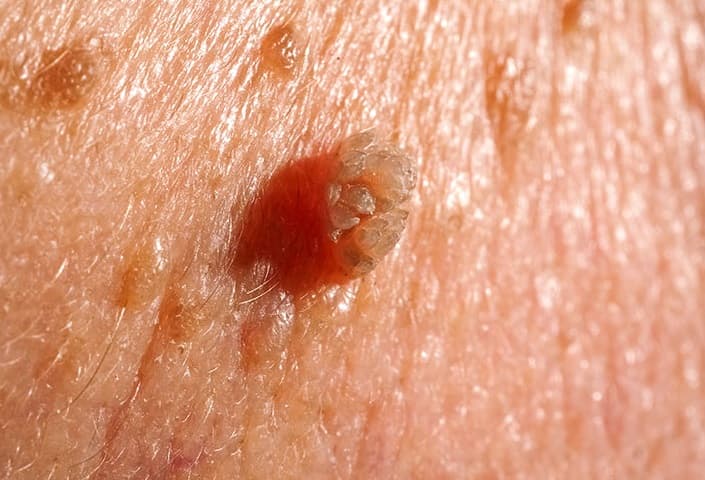 Sùi mào gà ban đầu xuất hiện các nốt đơn lẻ nhưng sau đó phát triển thành cụm trông giống như hình mào gà 