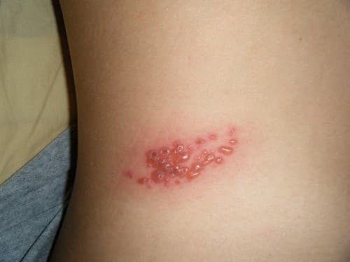 Triệu chứng ban đầu của zona là da nhạy cảm hoặc đau ở một phần cơ thể.