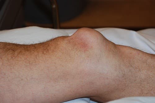 Vùng da quanh gối bị sưng lên đáng kể là triệu chứng của tràn dịch khớp gối.