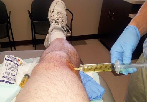 Chọc dịch khớp gối được thực hiện để chẩn đoán tràn dịch khớp gối.