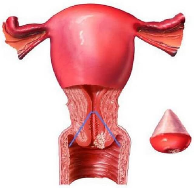 Cổ tử cung phì đại là gì? và ảnh hưởng sức khỏe như thế nào?