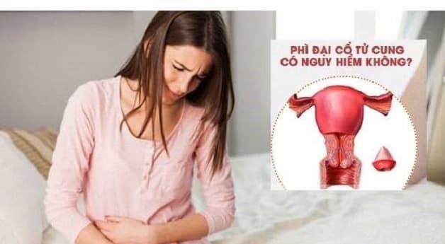 Phì đại cổ tử cung có thể ảnh hưởng đến việc thụ thai