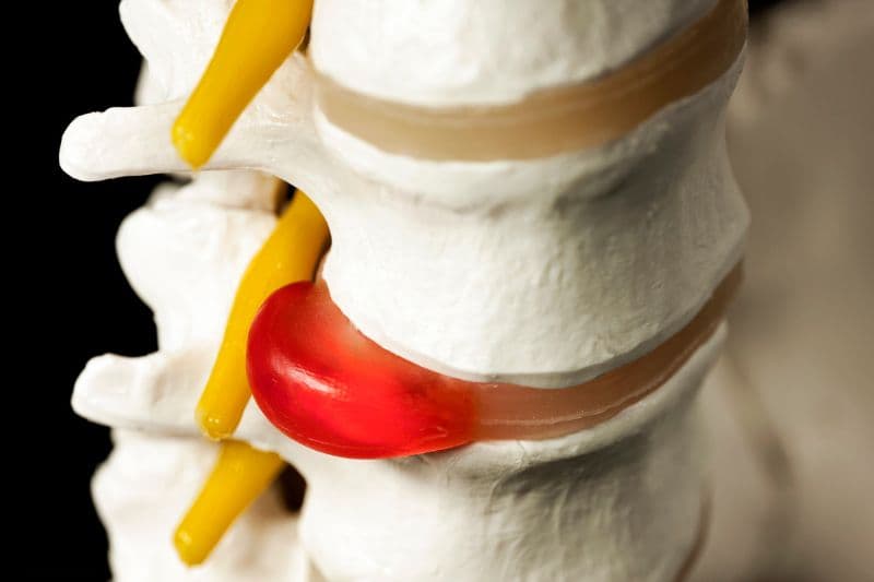 Bệnh thoát vị đĩa đệm là gì