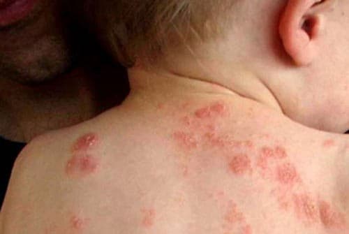 Bệnh ngoài da thường gặp ở trẻ em Hiện tượng hạt kê