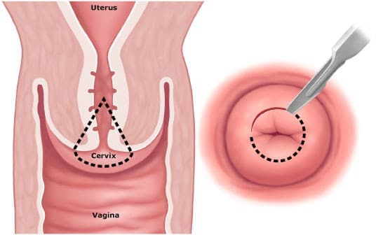 ung-thu-co-tu-cung-co-con-duoc-khong1