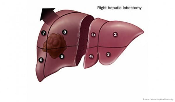 ung-thu-gan-co-chua-duoc-khong1 (2)