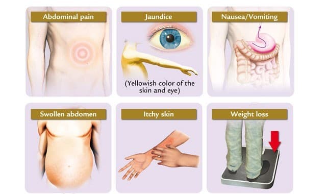 dau-hieu-ung-thu-gan