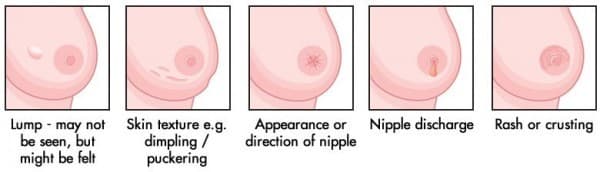 trieu-chung-ung-thu-vu