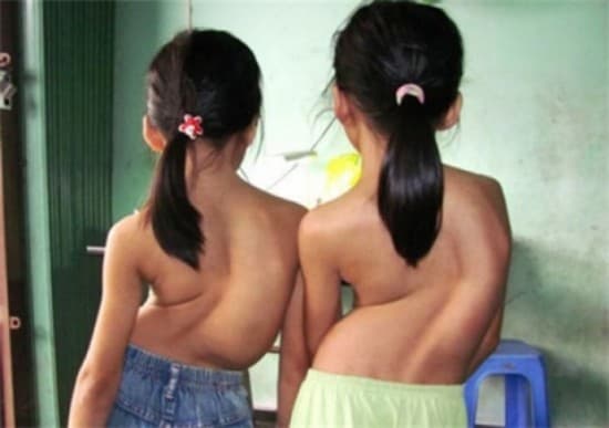 Vẹo cột sống điều trị thế nào?