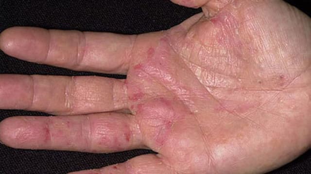 Bệnh chàm tổ đỉa có lây không?