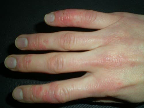 Bệnh Raynauld xảy ra khi các động mạch nhỏ, các mao mạch máu bị co thắt, gây biến đổi màu sắc da và thiếu dưỡng vùng mô mà mạch máu đó nuôi dưỡng. 