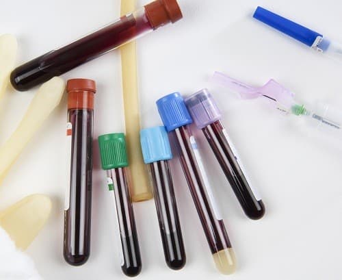 Xét nghiệm điện đi hemoglobin giúp chẩn đoán loại thiếu máu mà người bệnh mắc phải.