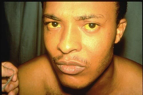 Để chẩn đoán vàng da, xác định nguyên nhân và mức độ nghiêm trọng của tình trạng này, người bệnh cần thực hiện một số xét nghiệm theo chỉ định của bác sĩ. 