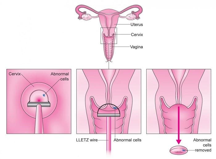 Điều trị ung thư cổ tử cung