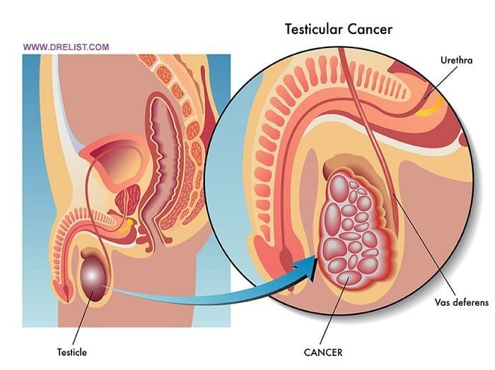 Điều trị ung thư tinh hoàn