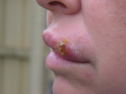Vết lở do siêu vi herpes simplex ( HSV-1) gây ra và có thể lây nhiễm.