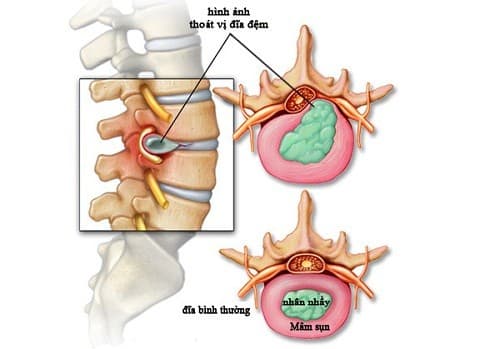 Thoát vị đĩa đệm gây tê chân