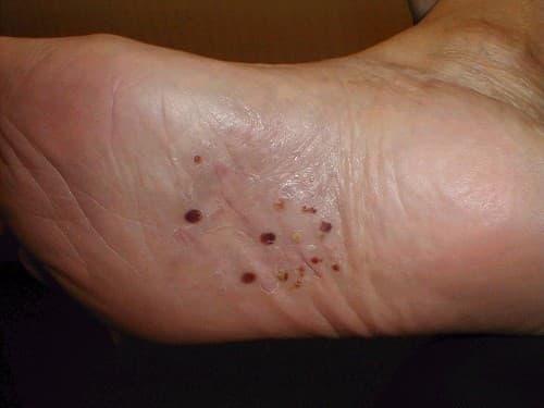 Bệnh chàm tổ đỉa có triệu chứng đặc trưng là xuất hiện mụn nước ở mặt sau, mặt bên ngón tay, lòng bàn tay, mặt dưới, mặt bên các ngón chân, lòng bàn chân. 