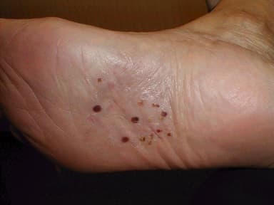 Thuốc trị bệnh chàm tổ đỉa Tại Bệnh viện Thu Cúc