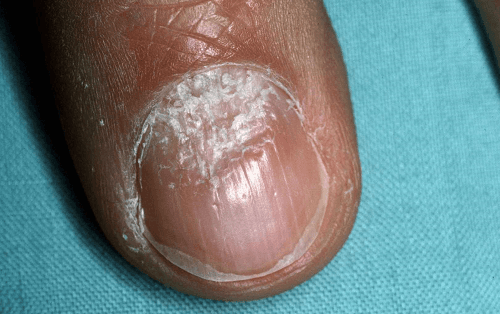 Bệnh vẩy nến móng tay thường được phát hiện khi người bệnh nhận thấy có những bất thường ở móng tay.