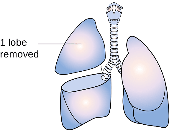 ung-thu-phoi-co-chua-duoc-khong