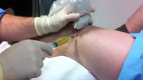 Trong xét nghiệm chọc hút dịch khớp bác sĩ sẽ dùng một cây kim để chọc hút dịch ở vùng khớp bị ảnh hưởng. 