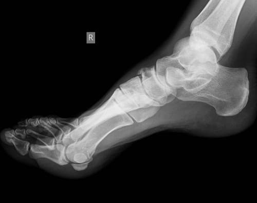 Chụp X - quang giúp phát hiện được hình ảnh lắng đọng tinh thể urate tại sụn khớp ở những cơn gút cấp đầu tiên hoặc ngay cả khi chưa có triệu chứng lâm sàng.