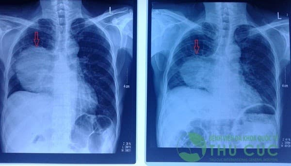 Sưng đau đầu ngón tay