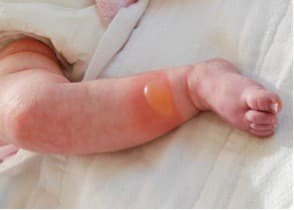 benh choc-lo-o-tre-em-cho-coi-thuong.1jpg