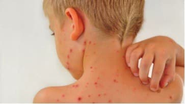 benh choc-lo-o-tre-em-cho-coi-thuong