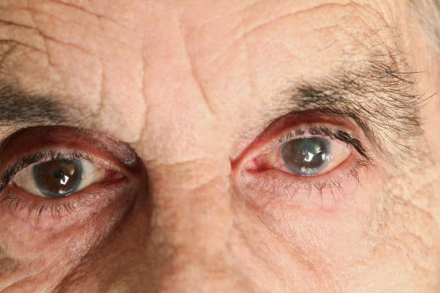 Bệnh về mắt nguy hiểm; đục thủy tinh thể