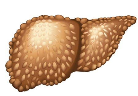 de-mac-cac-benh-gan-mat-sau-tuoi-50.2jpg