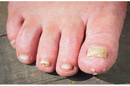 nấm móng chân ở trẻ