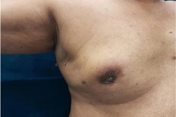 triệu chứng bệnh ung thư vú ở nam giới điển hình 