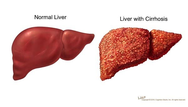 viem-gan-c-va-ung-thu-gan
