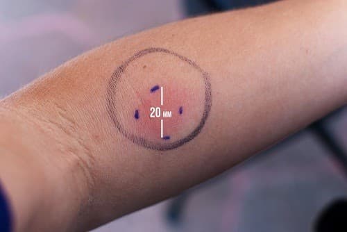 Người bệnh cần thông báo cho bác sĩ biết nếu trước đây đã có phản ứng nghiêm trọng với xét nghiệm lao qua da. 