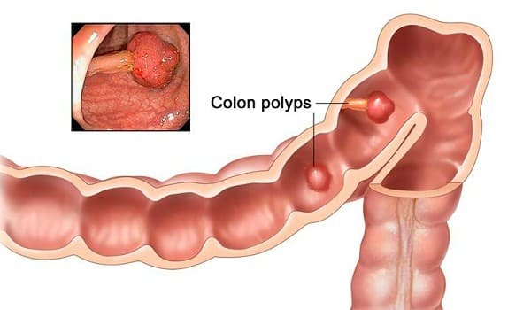 polyp đại tràng