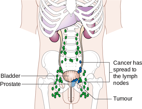 qua-trinh-phat-trien-cua-ung-thu3