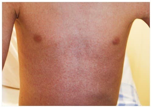 Triệu chứng của dị ứng thuốc thường gặp nhất là nổi mề đay, phát ban hoặc sốt. 